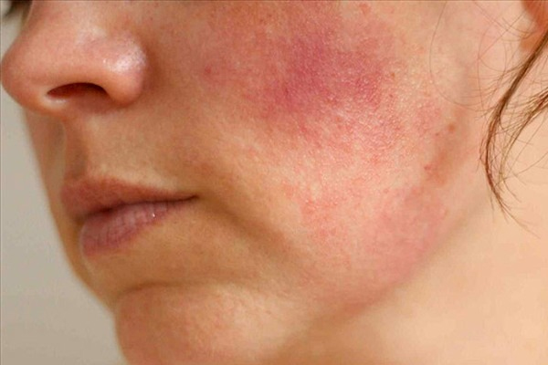 Dị ứng da mặt thường xảy ra ở phụ nữ.jpg